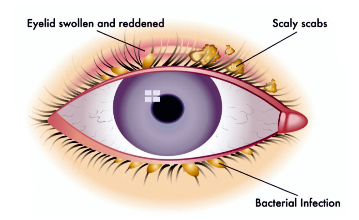 Blepharitis The Stoneygate Eye Hospital Leicester